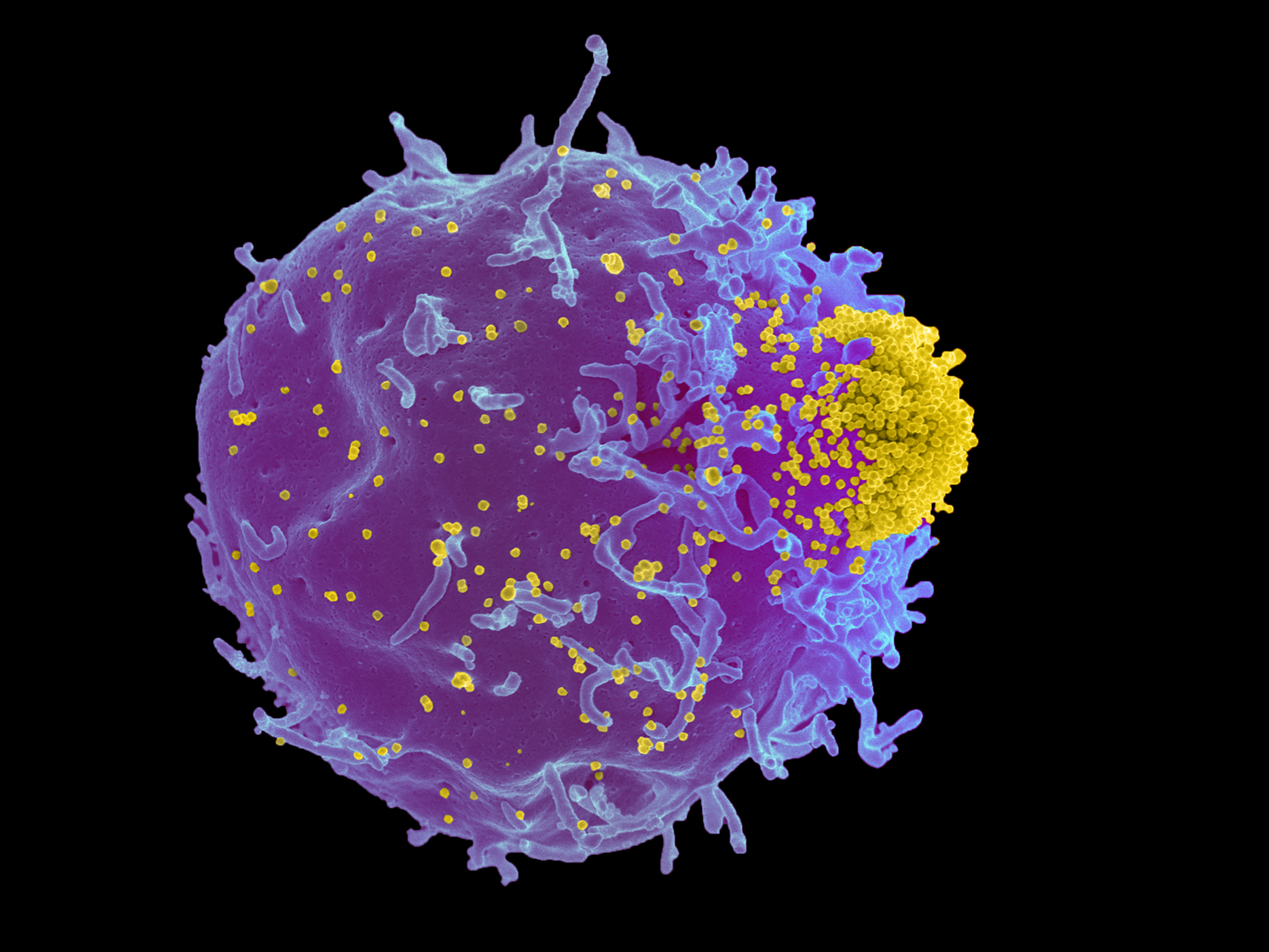 This electron microscope image shows yellow particles of a mouse leukemia virus named Friend virus emerging or "budding" out of an infected white blood cell known as a T-cell. By allowing the Friend virus to mutate and evolve in mice, University of Utah researchers produced new evidence that an arms race between microbes and immune-system MHC genes is responsible for maintaining an amazing diversity of those genes, even though some of them are responsible for autoimmune and infectious diseases that make us sick.
