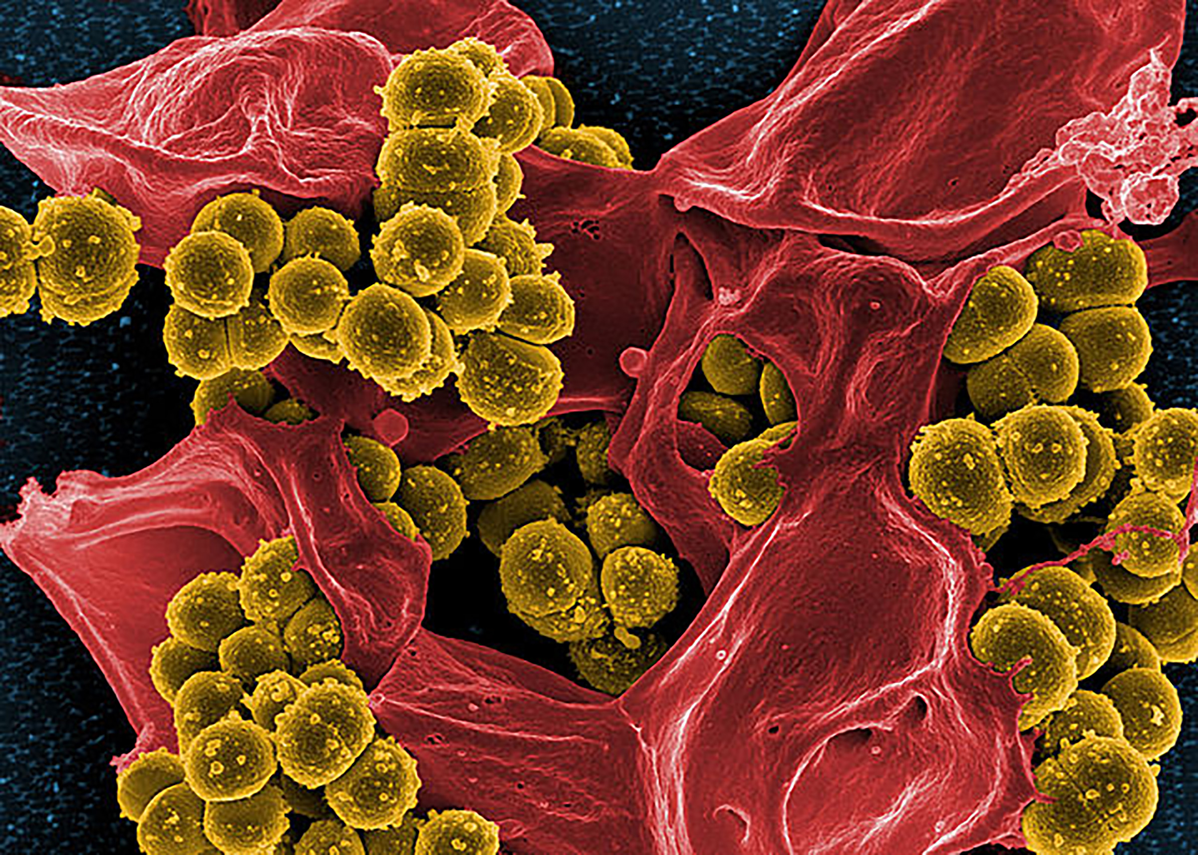 Scanning electron micrograph of Methicillin-resistant Staphylococcus aureus (MRSA) and a dead Human neutrophil.
