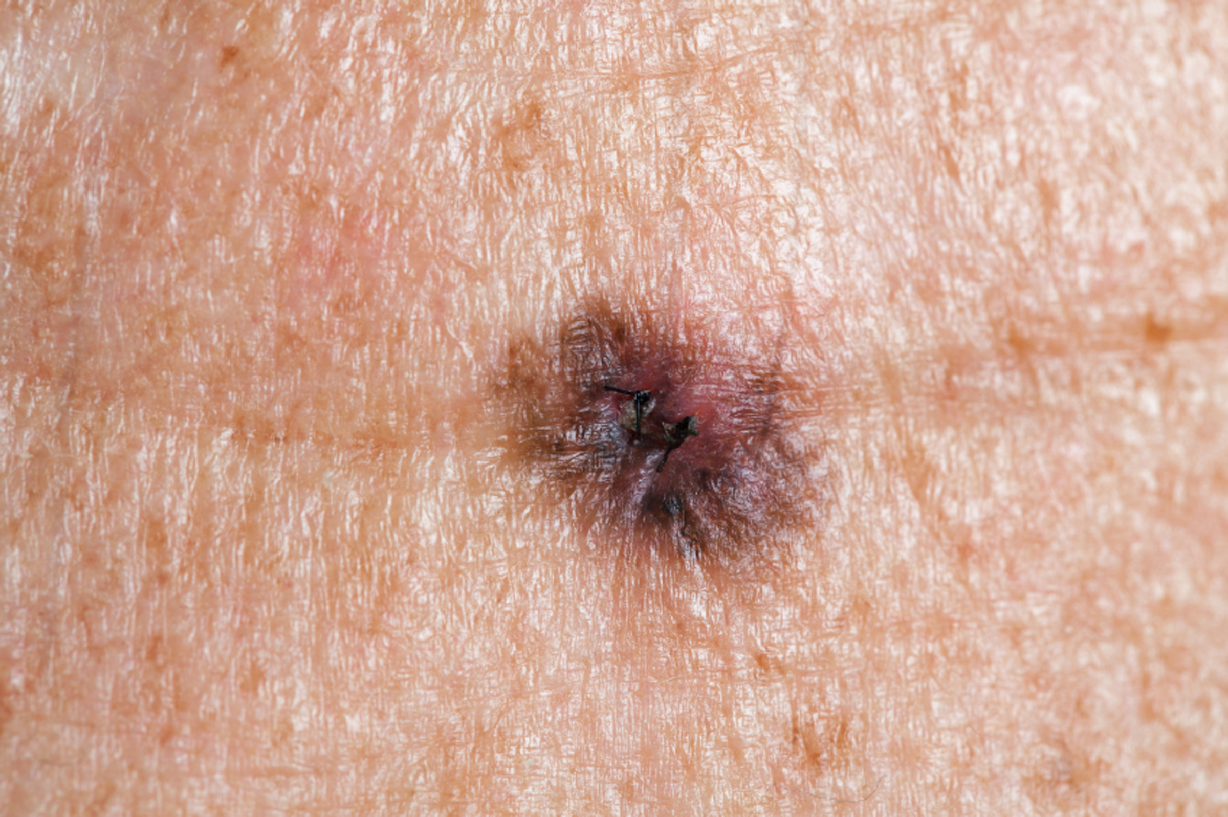 An image of Melanoma skin cancer.