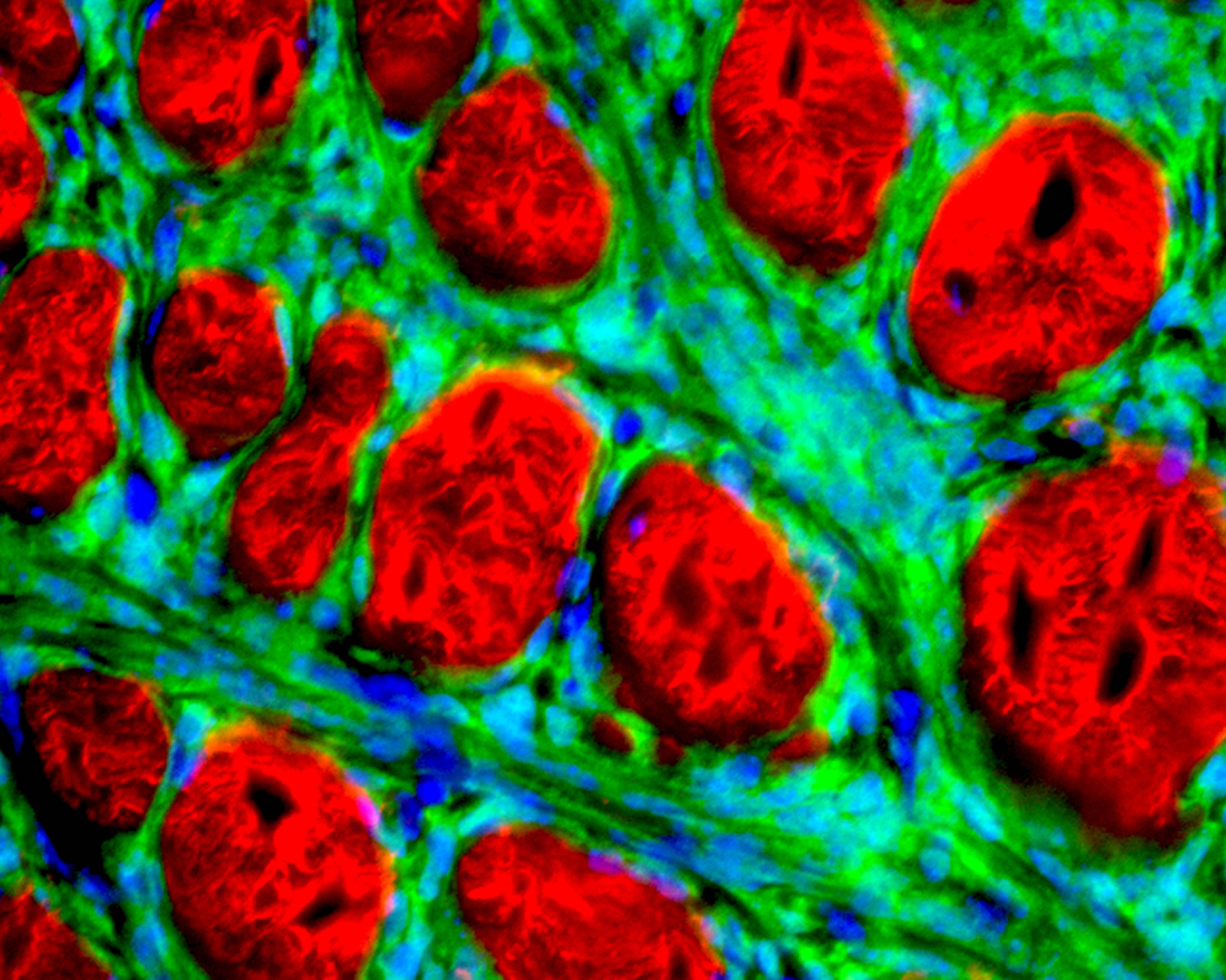 University of Utah researchers have engineered a mouse that can develop synovial sarcoma, an aggressive and often lethal human cancer that most frequently afflicts teenagers and young adults. The mouse "model" for the human cancer not only should speed the search for new treatments, but revealed the cancer originates in muscle precursor cells called myoblasts. The photo shows a microscopic, cross-section view of part of a synovial sarcoma tumor. The cancerous cells are green and developed from myoblasts. They surround red-colored muscle fibers. Cell nuclei are blue, and the cancer cell nuclei are particularly visible.