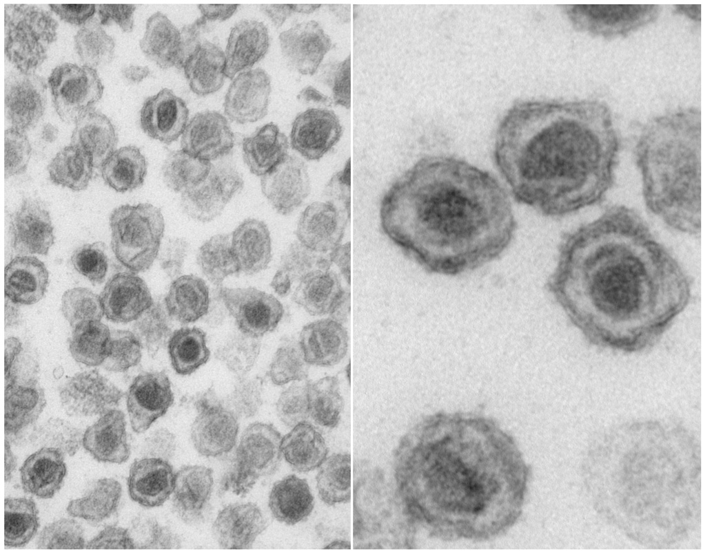 XMRV virus particles, which have been found in human prostate cancer cells, as visualized by transmission electron microscopy.
